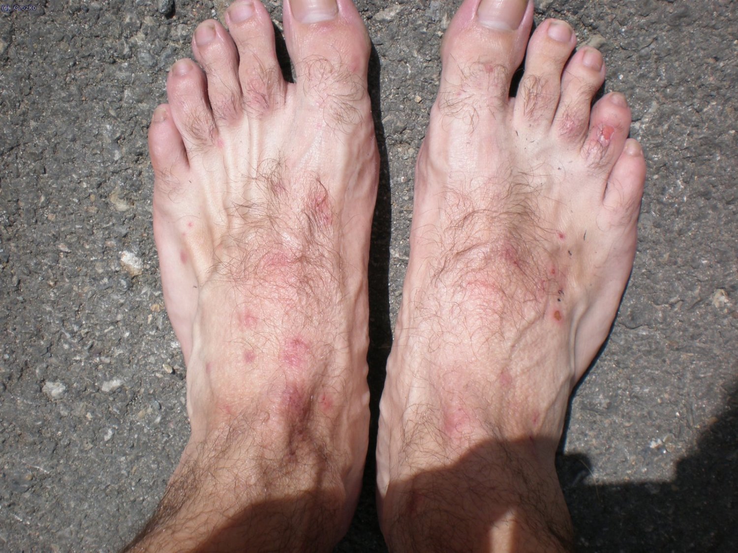 Pies despues de un ataque de mosquitos.